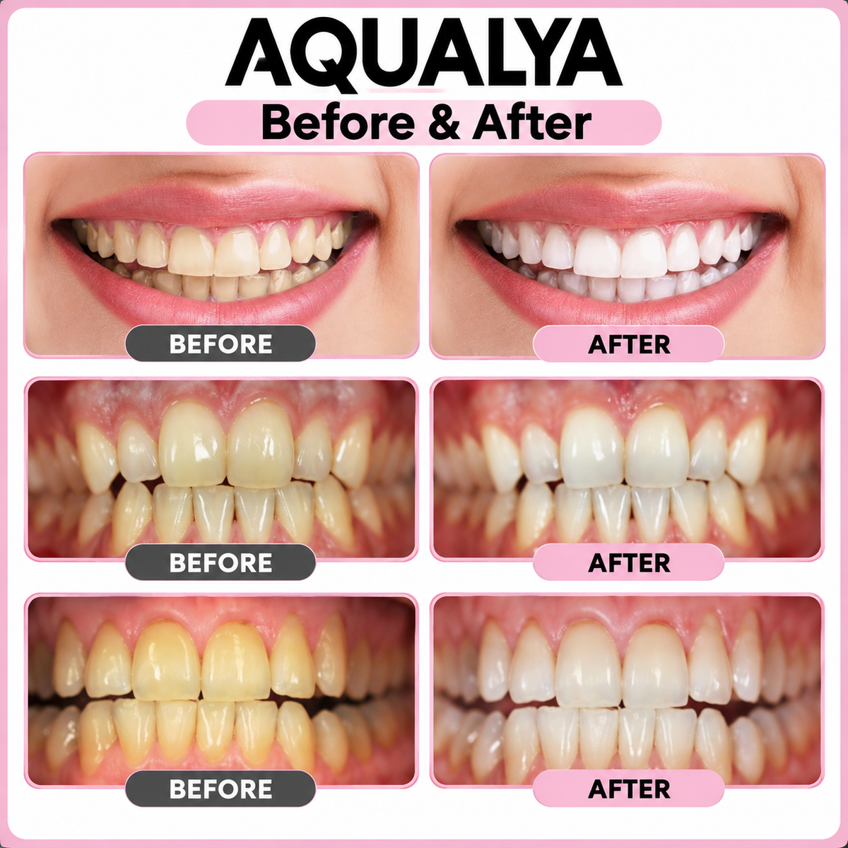 Teeth Whitener – For a Brighter-Looking Smile